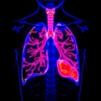 dual-gain-color-nir-chip-enables-fluorescence-guided-lung-and-breast-cancer-surgery