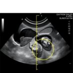 diaphragm-ultrasound-reveals-differences-in-lung-aeration-between-smaller-and-typical-newborns