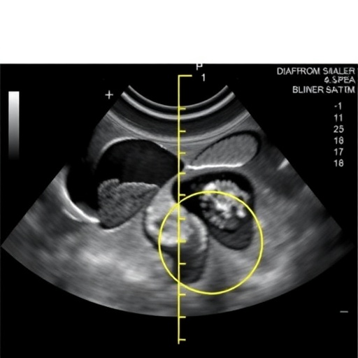 diaphragm-ultrasound-reveals-differences-in-lung-aeration-between-smaller-and-typical-newborns