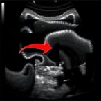 deep-learning-precisely-grades-schistosoma-japonicum-liver-fibrosis-using-ultrasound-images