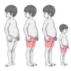atopic-dermatitis-phenotypes-linked-to-long-term-body-mass-index-trajectories