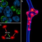 study-reveals-how-nf1-loss-enables-er-positive-breast-cancer-bone-metastasis