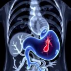 ruptured-hepatic-artery-aneurysm-into-biliary-tract-during-lvad-support-successfully-embolized