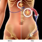 revisional-roux-en-y-bypass-after-sleeve-gastrectomy-affects-bone-health-in-postmenopausal-women