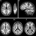 mild-cognitive-impairment-shows-distinct-brain-atrophy-patterns-with-clinical-implications