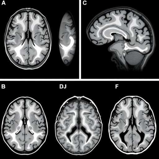 mild-cognitive-impairment-shows-distinct-brain-atrophy-patterns-with-clinical-implications