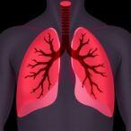 initial-dose-tarlatamab-associated-tumor-lysis-syndrome-in-small-cell-lung-cancer