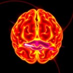 hypertonic-saline-regimen-linked-to-lower-mortality-in-severe-brain-injury