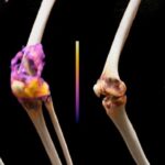 car-t-cell-therapy-puts-severe-rheumatoid-arthritis-into-remission-in-first-clinical-trial