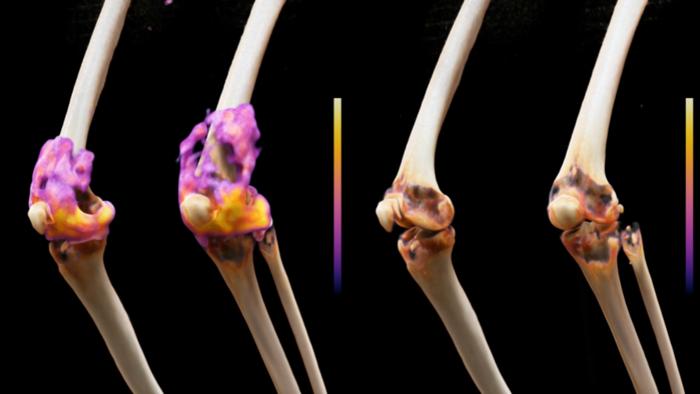car-t-cell-therapy-puts-severe-rheumatoid-arthritis-into-remission-in-first-clinical-trial
