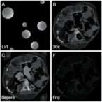 lipid-remodeling-in-serum-and-tumor-margins-tracks-colorectal-cancer-progression