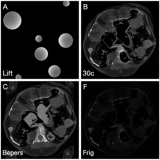 lipid-remodeling-in-serum-and-tumor-margins-tracks-colorectal-cancer-progression