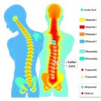 injury-site-monitoring-after-spinal-cord-injury:-109-patients-across-five-icus