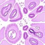 waldenstrom’s-macroglobulinemia-in-siblings:-25-years-of-institutional-cases-reviewed
