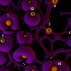 pancreatic-cancer-organoids-uncover-genes-driving-chemotherapy-resistance