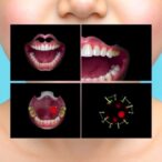pediatric-behcet’s-disease-marked-by-recurring-oral-and-genital-ulcers