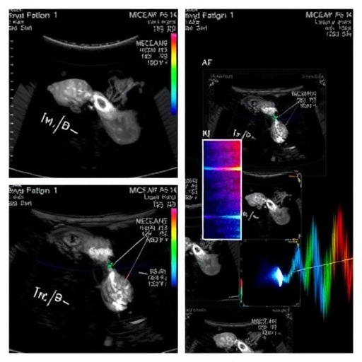 ultrafast-ultrasound-with-phrenic-stimulation-diagnoses-diaphragm-dysfunction-noninvasively