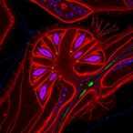 losing-desmoplakin-in-lung-epithelium-triggers-fibrotic-wnt-signaling-in-vitro
