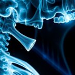 jaw-bone-death-risk-in-osteoporosis-patients-on-antiresorptive-drugs