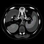 multicenter-study-predicts-kidney-cancer-grade-using-multi-phase-ct-radiomics