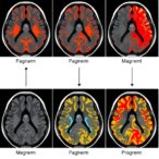 systematic-review-weighs-machine-learning-for-acute-ischemic-stroke-segmentation