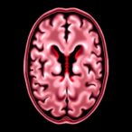 risk-factors-for-shunt-conversion-and-brain-bleeding-after-ventriculosubgaleal-shunts
