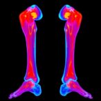 dual-radioligand-therapy-targets-neuroendocrine-bone-metastases-in-pilot-study