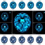 feature-weighted-pcnn-classifies-big-medical-data-efficiently-using-mapreduce
