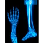 il12rβ1-deficiency-causes-multifocal-osteomyelitis-after-bcg-vaccination:-a-case-report