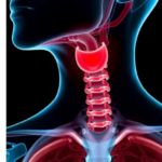 rare-high-grade-thyroid-cancer-grew-into-a-13-cm-neck-mass-and-spread-to-the-lungs