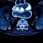 rare-arterial-injury-after-yttrium-90-radioembolization-reveals-hidden-vascular-risk