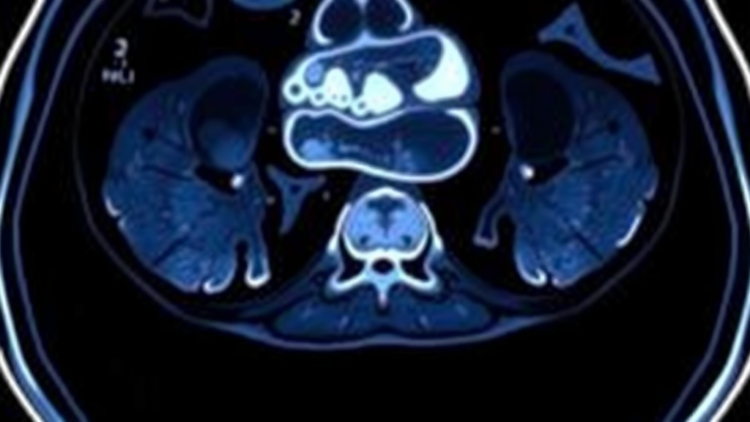 rare-arterial-injury-after-yttrium-90-radioembolization-reveals-hidden-vascular-risk