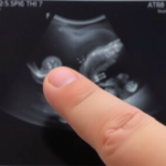 tiny-finger,-big-lesson:-ultrasound-reveals-hidden-toddler-fracture-x-rays-missed