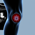 ultrasound-reveals-hidden-secrets-of-the-knee’s-forgotten-fat-pad