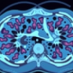 ai-learns-to-read-cancer-slides-like-a-pathologist-by-watching-the-neighborhood