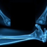 hidden-elbow-fracture-in-babies:-one-x-ray-clue-stands-out,-study-finds