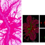 laser-dissected-proteomics-reveals-where-immunity-really-lives-in-triple-negative-breast-tumors
