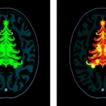 rare-fungal-brain-infection-reveals-striking-christmas-tree-sign-on-mri