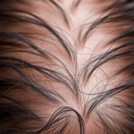 hair-loss-signals-emerge-in-fda-database-as-biologics-draw-new-safety-scrutiny