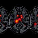 ai-reads-ultrasound-signals-to-predict-which-carotid-plaques-may-trigger-stroke
