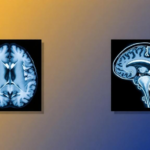 ai-workflow-turns-brain-mri-into-ct-like-images-to-sharpen-pet-scans