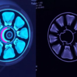 radiotherapy-still-matters-in-dmmr-endometrial-cancer,-researchers-warn-in-the-immunotherapy-era