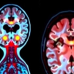 brain-scans-reveal-hidden-clues-to-gut-scarring-in-crohn’s-disease