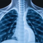 four-simple-measures-may-predict-who-survives-bacterial-pneumonia