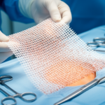 iron-loaded-surgical-mesh-offers-new-hope-against-hernias-after-high-risk-abdominal-surgery