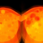 psma-pet-reveals-uneven-prostate-bed-recurrence-after-prostatectomy