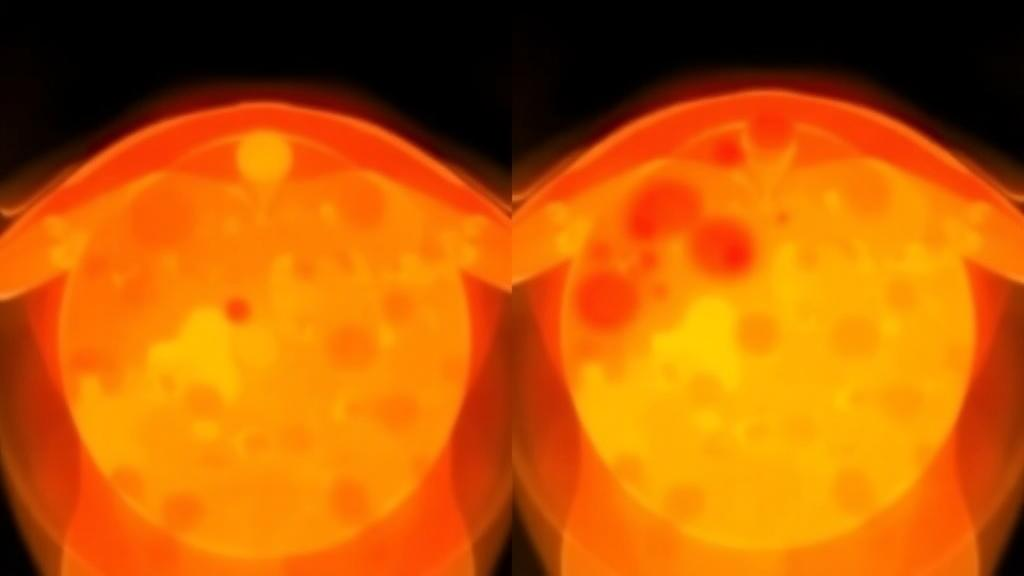 psma-pet-reveals-uneven-prostate-bed-recurrence-after-prostatectomy