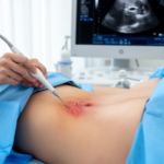 ultrasound-guided-sacroiliac-puncture-links-stronger-improvement-with-inflammatory-disease