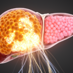 sp1-induced-pdrg1-drives-hepatocellular-carcinoma-growth-via-wnt/β-catenin-signaling