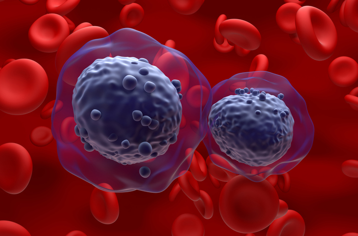 predicting-leukemia-survival-may-be-aided-by-six-gene-scoring-system